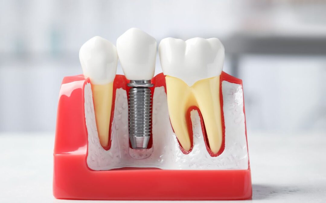 Can You Get Dental Implants If You’ve Been Missing Teeth for Years?