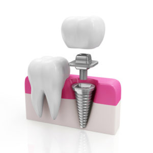 Dental Implants: High Tech Teeth