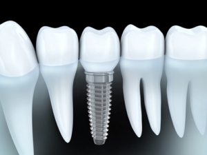 Dental-Implants-What-to-Expect-300x225