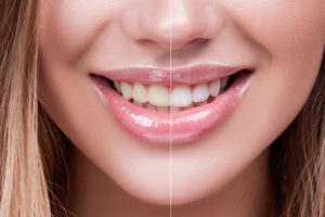 Teeth Bleaching vs. Teeth Whitening