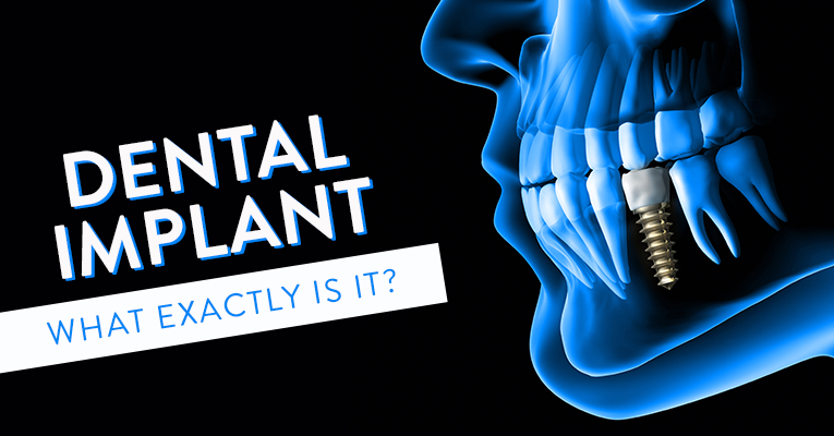 blog-what-is-a-dental-implant