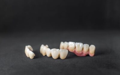 Can You Whiten Veneers? Expert Insights for a Brighter Smile