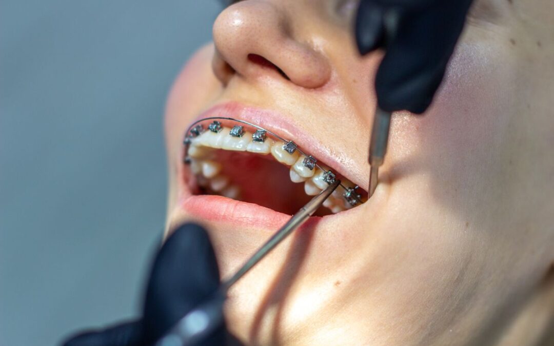 How Long Do Braces Take to Straighten Teeth?