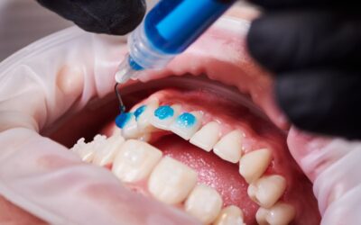 Metal Braces vs. Ceramic Braces: Which One Suits You Best?