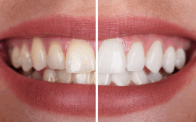 Can Whitening Damage Existing Dental Work? What Happens to Your Crowns and Fillings