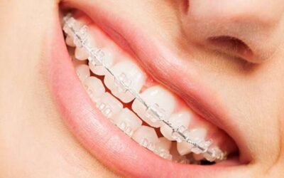 Clear Braces: A More Subtle Way to Straighten Your Teeth as Adults