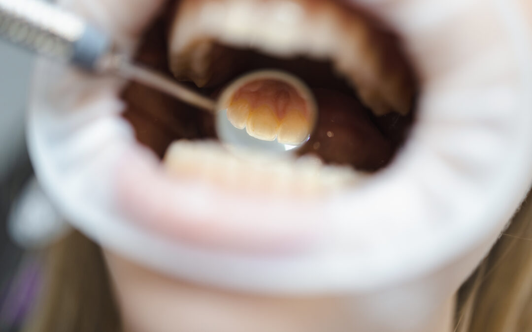 Gum Disease Treatment in Amarillo, TX | Periodontal Care